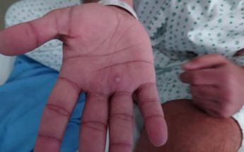 Suman 9 casos de viruela del mono en Nuevo León, confirma Salud