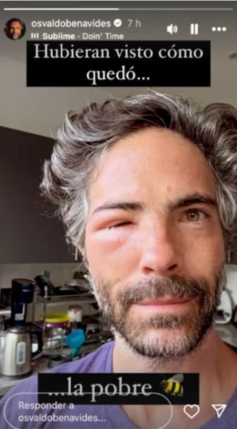 Osvaldo Benavides bromeó con sus seguidores al mostrarle su picadura de abeja,