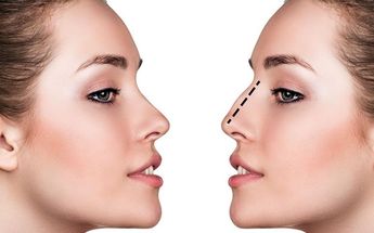 ¿Cuánto cuesta una rinoplastia en Monterrey? | Especial