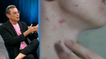 Automedicación y tendencias virales agravan el acné: dermatólogo