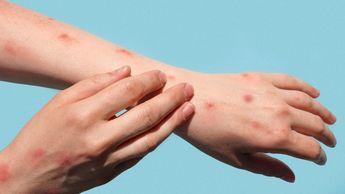 El sarampión es una enfermedad altamente contagiosa que se puede transmitir por el aire | iStock