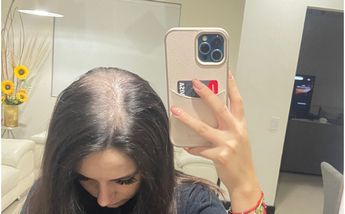 Monserrat Contreras caída de cabello