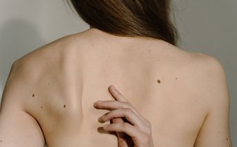 Día Mundial del Melanoma: Si notas estos 7 cambios en tus lunares, debes checarte con el médico / Pexels