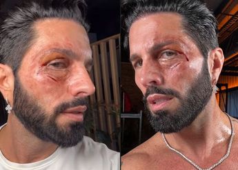 Poncho de Nigris compartió fotografías de su rostro con la cara golpeada / Instagram
