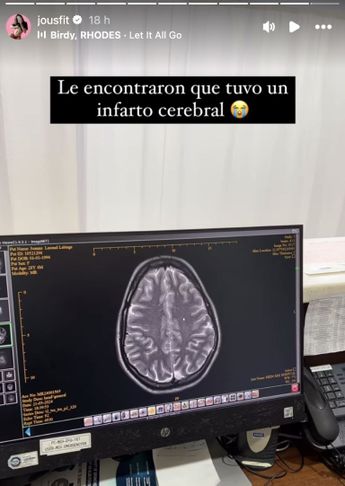 Jousfit sufre infarto cerebral