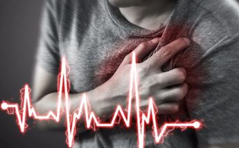 Infarto │ Archivo.