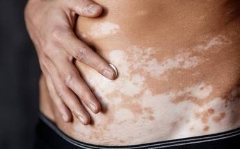 Este 25 de junio se conmemora el Día Mundial del Vitiligo