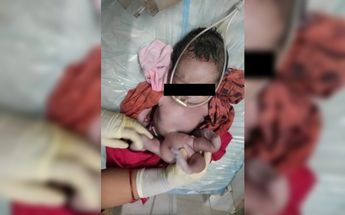Bebé con cuatro brazos y cuatro piernas / Especial