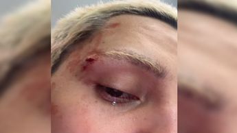 Herida de Kunno tras ser golpeado