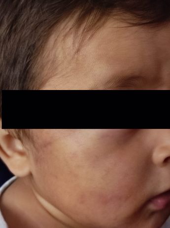 El menor presentaba diversas marcas en el rostro /Carlos Tejeda