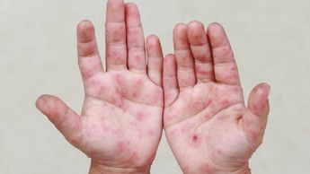 El virus Coxsackie se transmite por contacto o saliva y genera fiebre, ampollas y, en casos raros, complicaciones como meningitis.