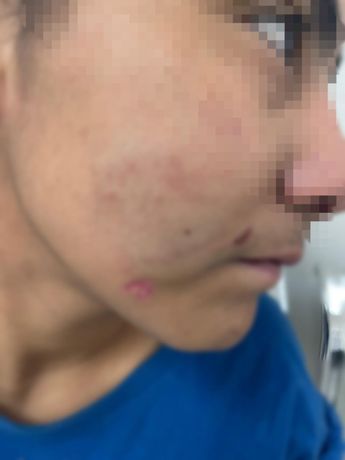 Heridas de la víctima, pareja del detenido en Guadalupe, Nuevo León. | Cortesía