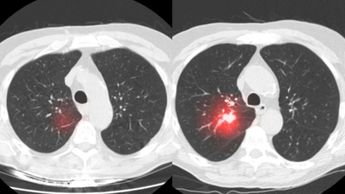 La IA predice con dos años de anticipación cáncer de pulmón | Especial