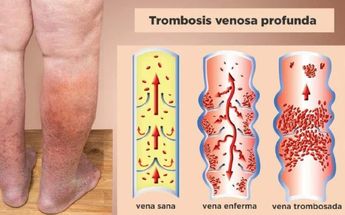 Trombosis venosa profunda | Especial