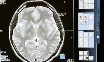 Materia gris y blanca dentro del cerebro. / Canva.