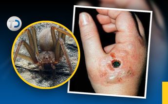 La mordida de una araña violinista puede provocar la muerte debido a que su veneno disuelve los tejidos.| Antonio Texta