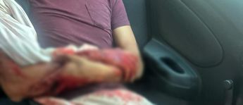 Una de las piernas del hombre quedó gravemente lesionada, al desprendérsele la piel / Especial