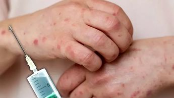 Fiebre, escurrimiento nasal y manchas blancas en la boca forman parte del cuadro inicial del sarampión, una infección viral muy contagiosa.