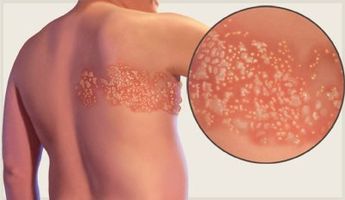 Herpes Zóster, enfermedad que puede ser causada por el virus de la varicela