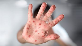 En México, se han registrado contagios de viruela del mono principalmente en hombres | Freepik