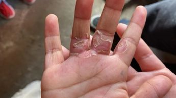 El niño de 4 años acusó que el hombre le quemó las manos en la estufa | Especial