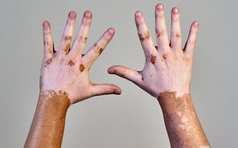 El vitiligo es una enfermedad autoinmune que puede afectar a cualquier grupo de edad | Especial