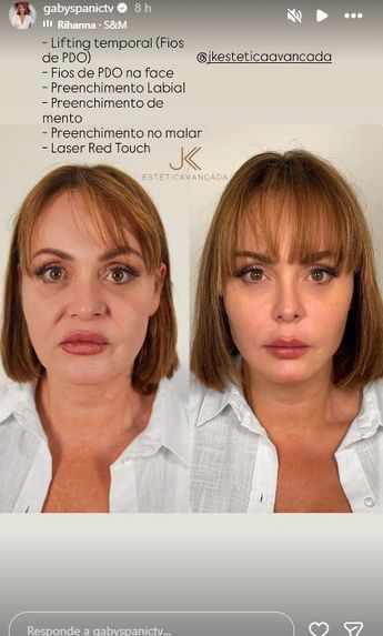Gaby Spanic comparte con sus fans qué se hizo en el rostro. | FOTO: Instagram
