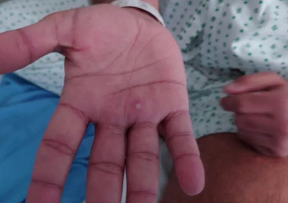 Suman 9 casos de viruela del mono en Nuevo León, confirma Salud
