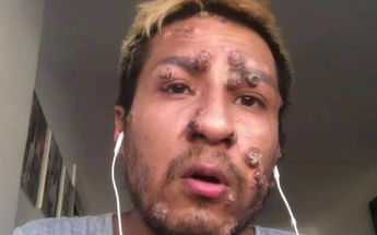 Anthony, el peruano que reside en España y que se enfermó de viruela del mono / Cuatro al Día
