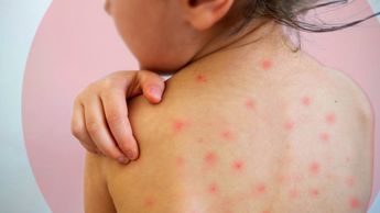 Autoridades de salud han implementado una estrategia intensiva de vacunación para combatir el sarampión | Freepik