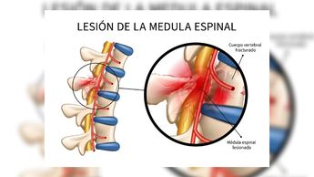 Derrame espinal | Especial