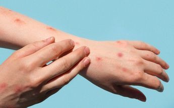 El sarampión es una enfermedad altamente contagiosa que se puede transmitir por el aire | iStock