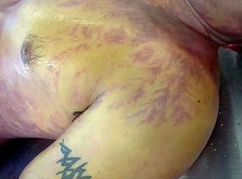 La figura de Lichtenberg son las marcas que deja un rayo al caer sobre una persona | Cortesía Revista Chilena de Anestesia