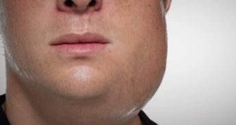 Las paperas son una enfermedad altamente contagiosa, sobre todo entre la población no vacunada. | Archivo