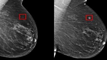 El carcinoma es detectado con IA en una mamografía | Especial